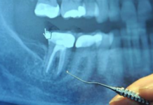 97% of Terminal Cancer Patients Previously Had This Dental Procedure