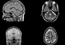 What if I Told You Cannabis Protects Against and Even Reverses Brain Damage