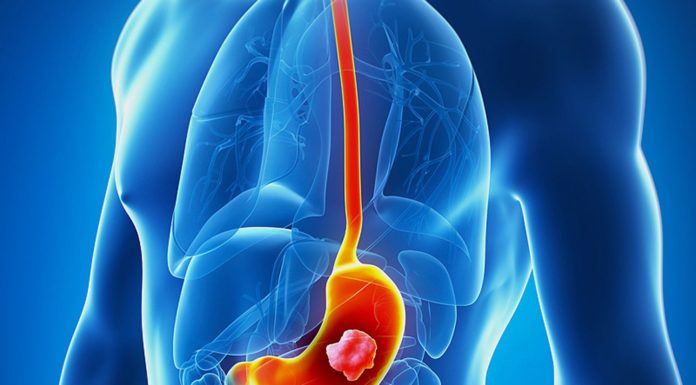 The Scientist Found That This Vitamin Prevents The Risk Of Stomach Cancer