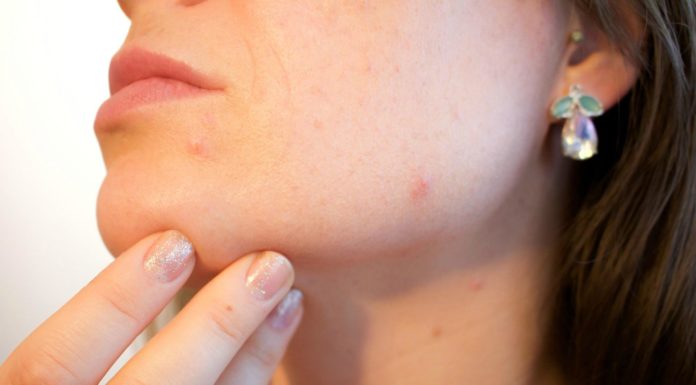 Prevent acne by changing your diet
