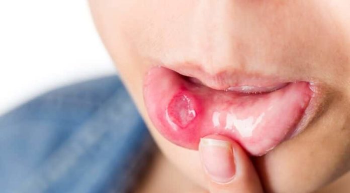 Cure Mouth Ulcers With These Amazing Herbs