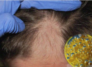 Three Spoonfuls a Day and You Will Recover Your Hair Lost by Baldness; Starts Today