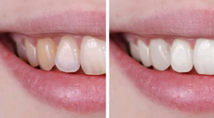 How To Get Whiter Teeth Without Damaging Your Enamel