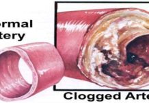 Top 6 Foods That Naturally Unclog Arteries