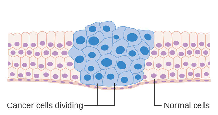 CONFIRMED: Cancer Is a Man-Made Disease, Your Lifestyle Causes Cancer Not Your Genetics