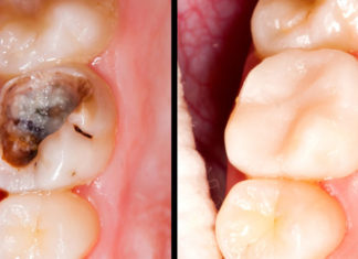 Cure Caries, Gum Disease and Whiten Teeth Using This Wonderful Remedy
