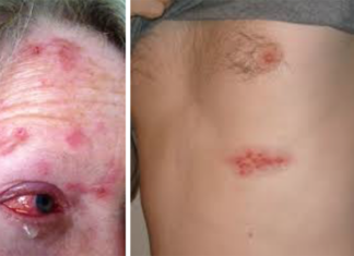 New Study: Chickenpox Vaccine Linked to Widespread Increase in Shingles