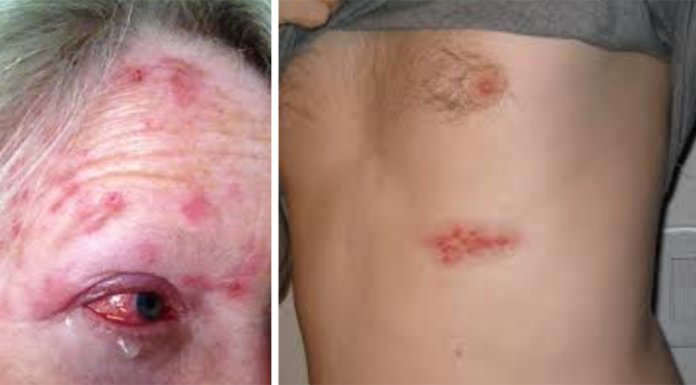 New Study: Chickenpox Vaccine Linked to Widespread Increase in Shingles