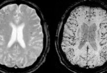 3 Mineral Waters That Can Remove Aluminum from the Brain