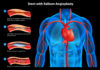 Clotting of the heart stent – is it possible?