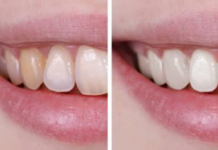 How To Get Whiter Teeth Without Damaging Your Enamel