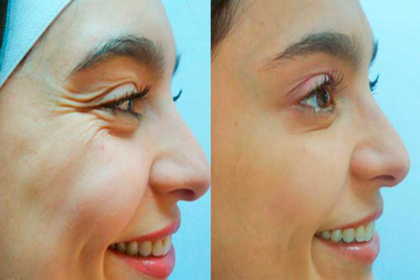 This Woman Managed To Remove Her Wrinkles In a Matter Of Hours Only With This Elixir of Youth