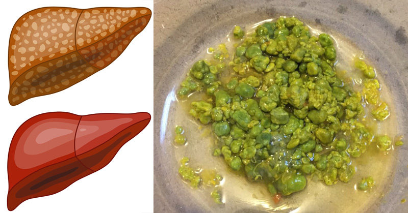 This Liver Detox Procedure Only Needs One Ingredient