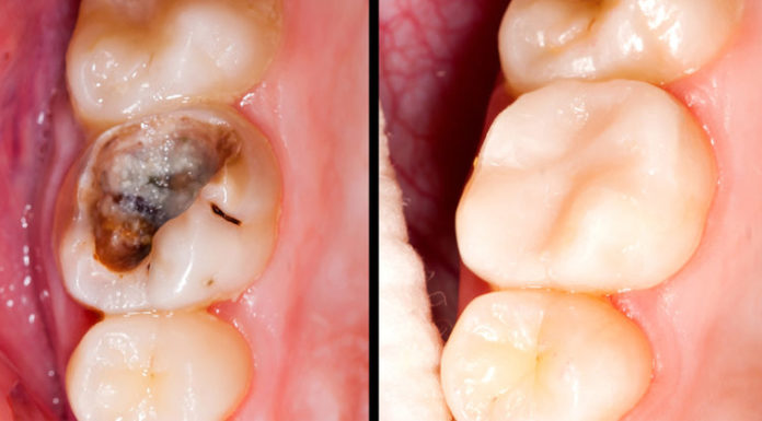 Cure Caries, Gum Disease and Whiten Teeth Using This Wonderful Remedy